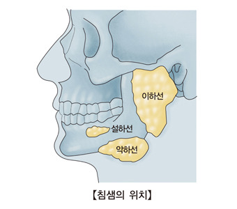 이하선 종양